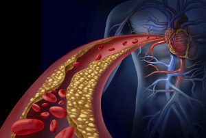 Clogged artery and atherosclerosis disease medical concept with a three dimensional human artery with blood cells that is blocked by plaque buildup of cholesterol as a symbol of arteriosclerotic vascular diseases.